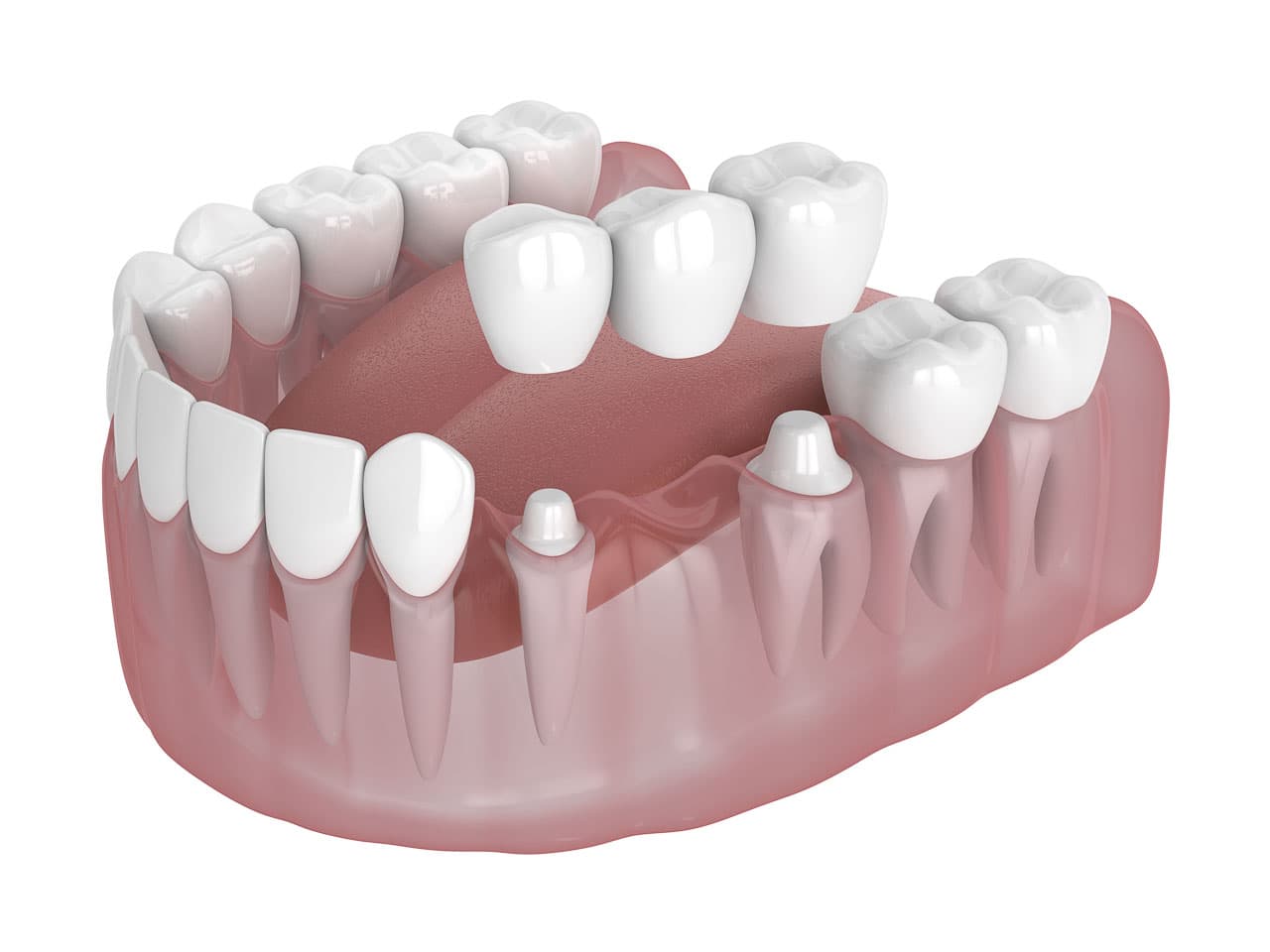 Peak Dental - Dental Bridges